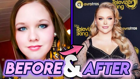 NikkieTutorials | Before and After Transformations | Her Cosmetic Surgery and More 