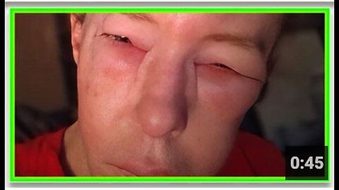 "Woman Severely Affected by Pfizer Vaccine Booster Shot"