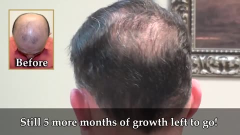 Dr. Brett Bolton: Hair Surgery Scar Completely Undetectable