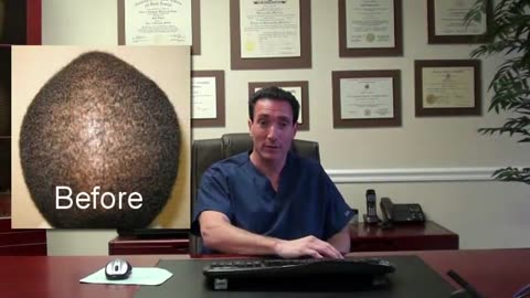 Dr. Brett Bolton Explains: How Many Hair Transplant Procedures Are Necessary?