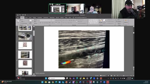 (CLIP) High Amyloidogenicity in Post-Mortem 'Calamari' Clots, Cardiologists Secretly Saying No ‘Vax’