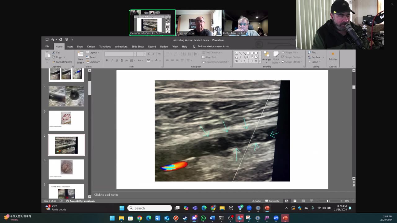 (CLIP) High Amyloidogenicity in Post-Mortem 'Calamari' Clots, Cardiologists Secretly Saying No ‘Vax’