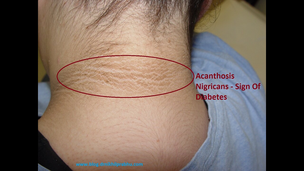 All of these things are DIABETES... Watch and learn!!!