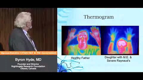 Thermogram, "Acquired Secondary" Raynaud's Phenomenon, Circulatory Dysfunction in Myalgic Encephalomyelitis - Byron Hyde, MD