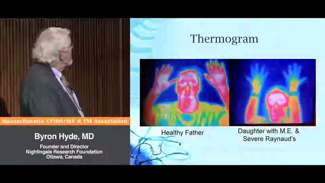 Thermogram, "Acquired Secondary" Raynaud's Phenomenon, Circulatory Dysfunction in Myalgic Encephalomyelitis - Byron Hyde, MD