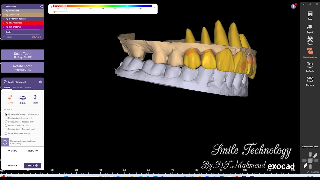 #design #naildesign #dental #dentaldesign #exocadexpert
