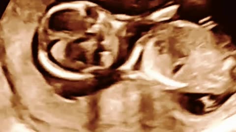 Sumathi Hospital: Gentle and Effective IUI Treatments in Madurai