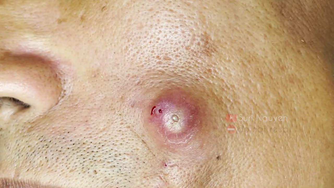 Blackheads Removal & Pimple Popper Cystic Acne Extraction 217