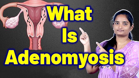 What Exactly Is Adenomyosis | Painful Bulky Uterus, Adenomyoma of Uterus | Homeopathy Medicine Cure
