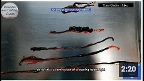 "VAXX-Induced Blood Blockages Successfully Removed from Artery in Beating Heart"