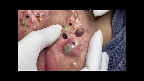 Facial Cleansing of pimple popper