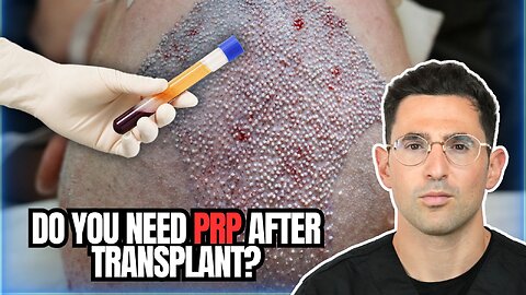 FAQ: Is PRP Mandatory After a Hair Transplant?