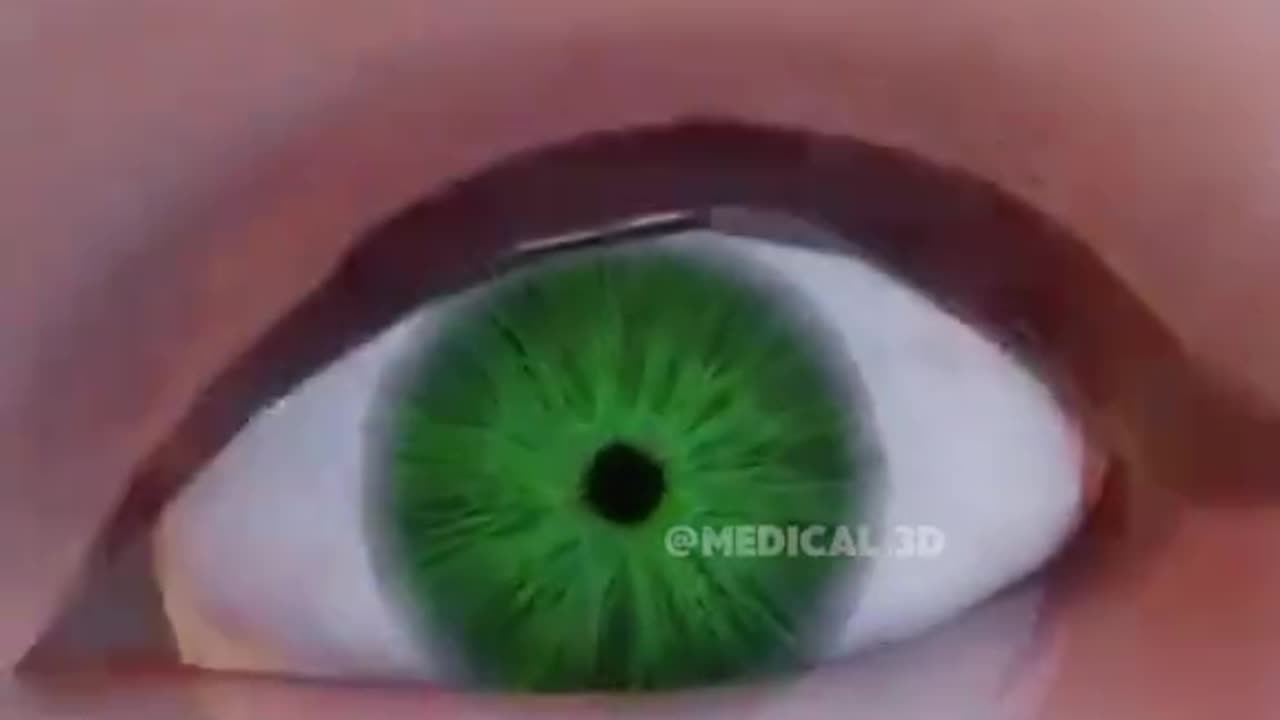 LASIK Eye Surgery (3D Animation)