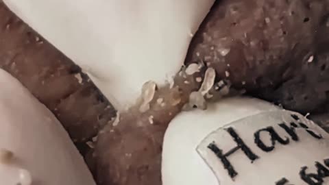 New satisfying blackhead removal #7