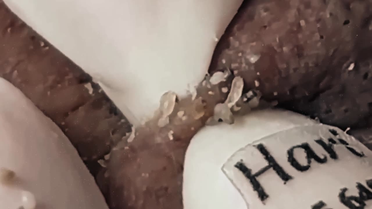 New satisfying blackhead removal #7