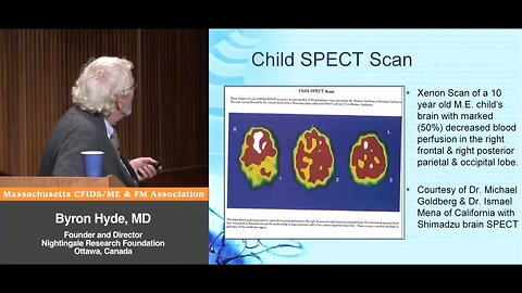 Xenon SPECT Scan in a child with M.E.. Jay Goldstein and Ismael Mena have been running these tests for years, and first demonstrated this in 1989 (Part 2) - Byron Hyde, MD