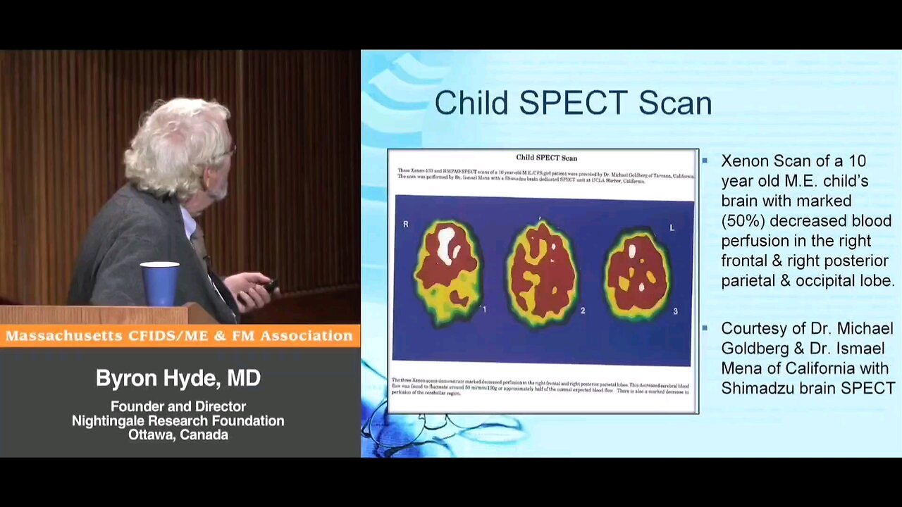 Xenon SPECT Scan in a child with M.E.. Jay Goldstein and Ismael Mena have been running these tests for years, and first demonstrated this in 1989 (Part 2) - Byron Hyde, MD