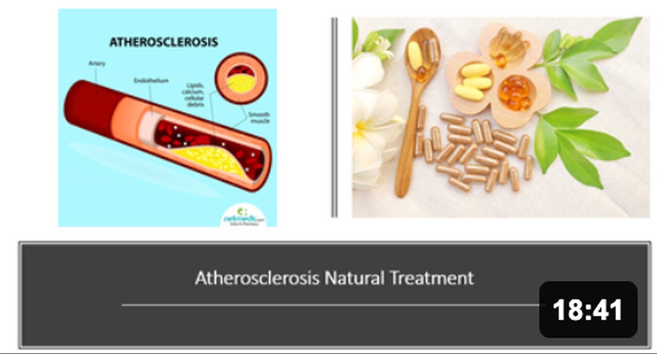 Atherosclerosis Natural Treatment