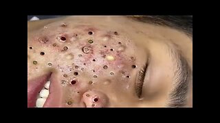 Blackheads Removal & Pimple Popper Cystic Acne Extraction 10