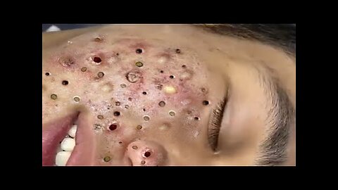 Blackheads Removal & Pimple Popper Cystic Acne Extraction 10