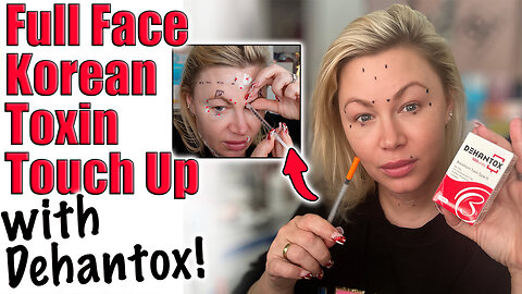 Full Face Toxin Touch Up w/ Dehantox ! AceCosm.com and code Jessica10 Saves you money
