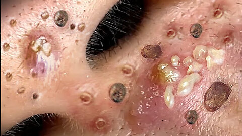 Satisfactory Blackhead Removal | Skin Cleansing Commented by a Beautician