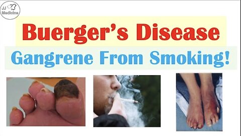 Buerger’s Disease (Ulcers & Gangrene From SMOKING!) Pathophysiology, Symptoms, Diagnosis, Treatment