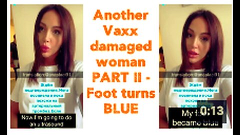 "Part II: Woman's Foot Turns Blue after Vaccine Damage"