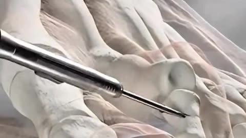 TEO Stabilization Surgery – Step-by-Step Medical Procedure