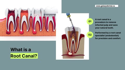 Root Canal Specialist in Calgary - Painless & Effective Treatment for a Healthy Smile!