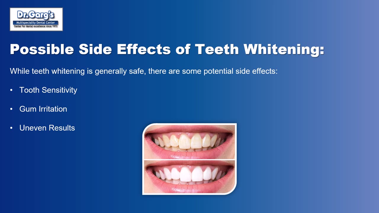 The Ultimate Guide to Teeth Whitening: Everything You Need to Know for a Brighter Smile