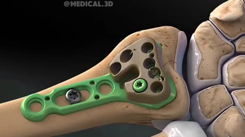 Distal Radius Fracture And Its Repair Surgery (3D Animation)
