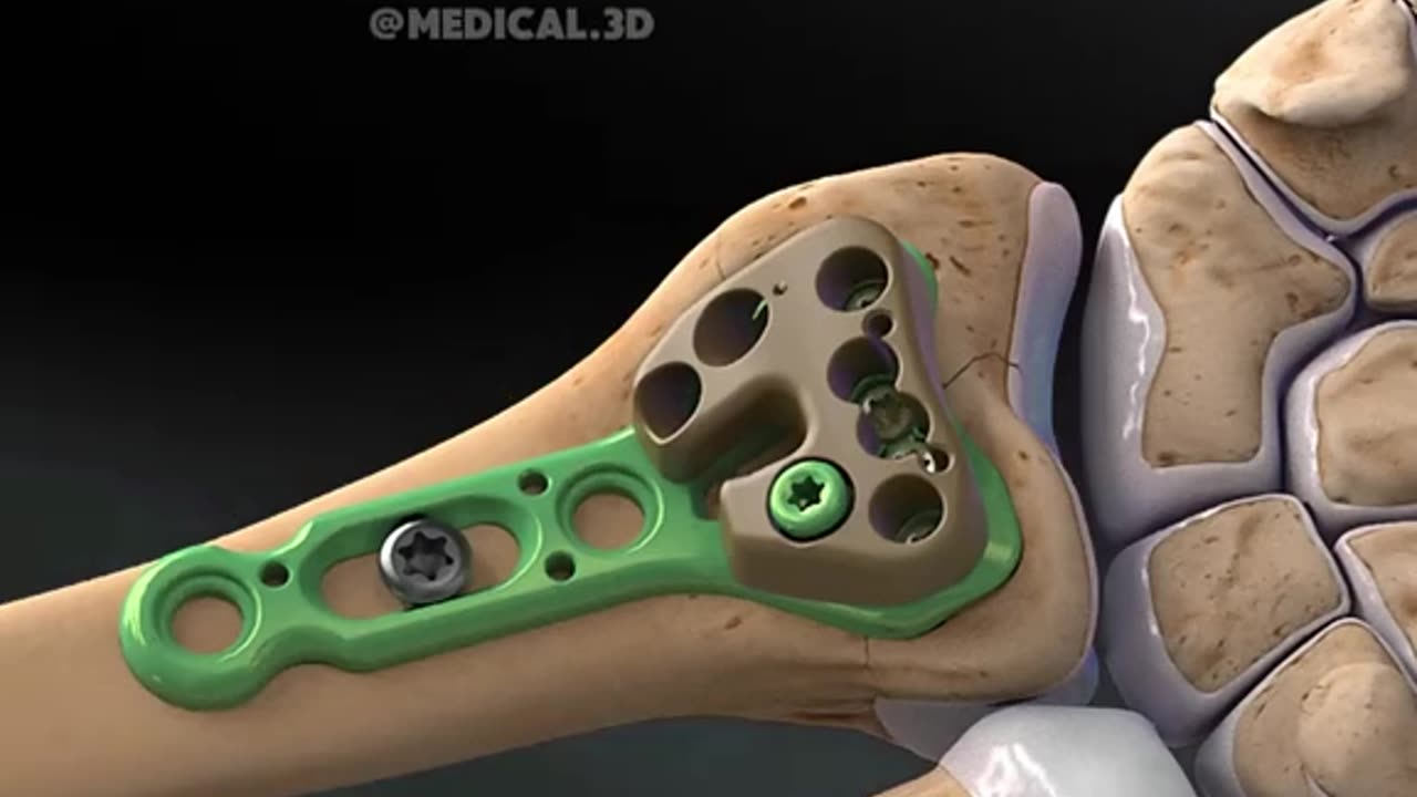 Distal Radius Fracture And Its Repair Surgery (3D Animation)