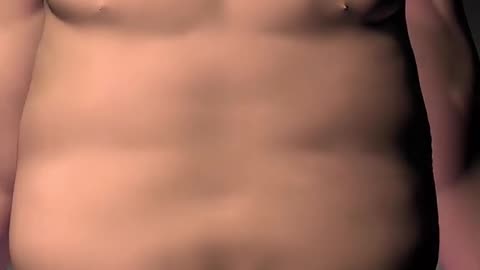 Sleeve Gastrectomy Surgery (3D Animation)