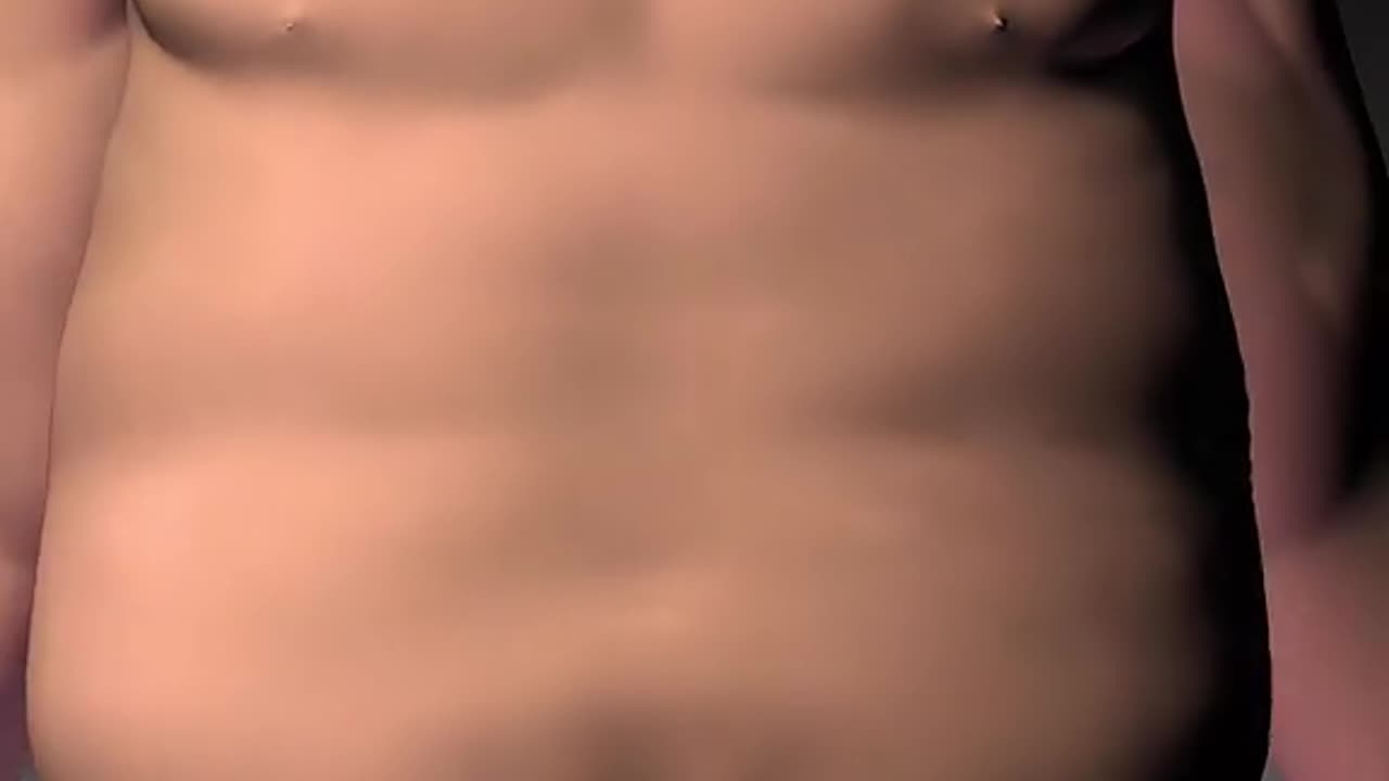 Sleeve Gastrectomy Surgery (3D Animation)