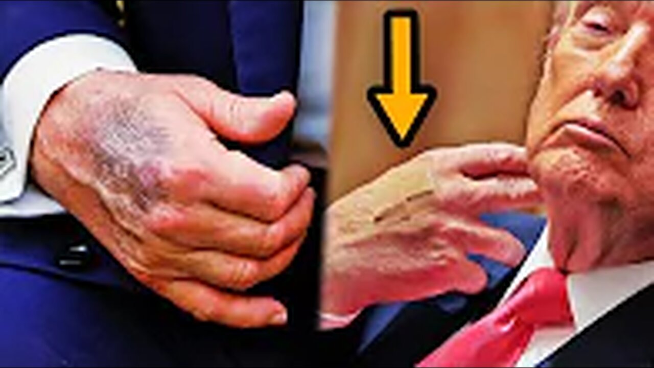 Media SILENCE on Trump’s disfigured hand