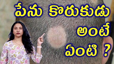 పేను కొరుకుడు అంటే ఏంటి? What is Alopecia Areata or Spot Baldness? Homeopathy Treatment Cure