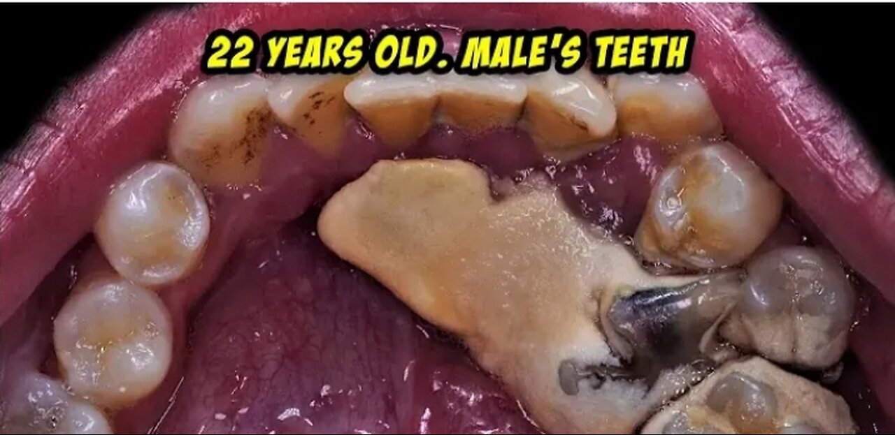 One Of The Biggest Tartar I,ve Ever Faced./Scaling.Dentist