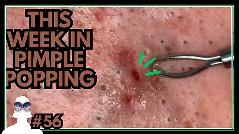 This Week In PIMPLE POPPING #56
