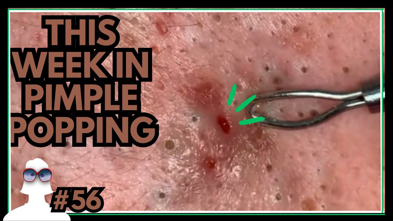 This Week In PIMPLE POPPING #56