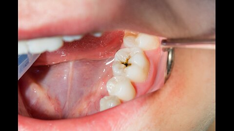 The real root cause of bleeding gums and tooth decay