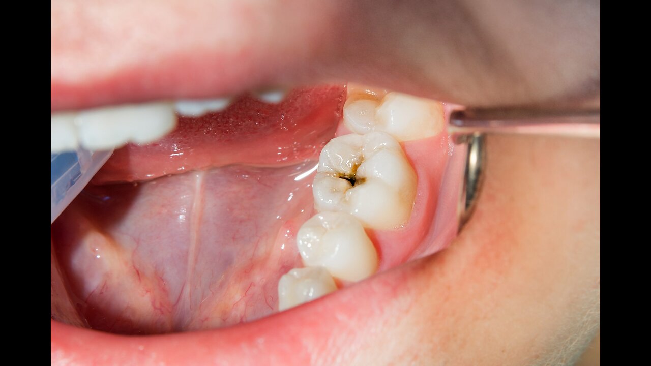 The real root cause of bleeding gums and tooth decay