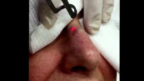Traumatic tattoo treated with the Tribeam laser For medical education NSFE