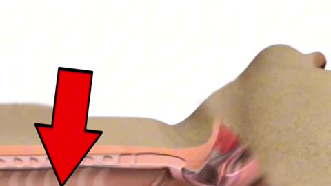 Stretching Throat To Treat Difficulty In Swallowing (Esophaeal Dilation)