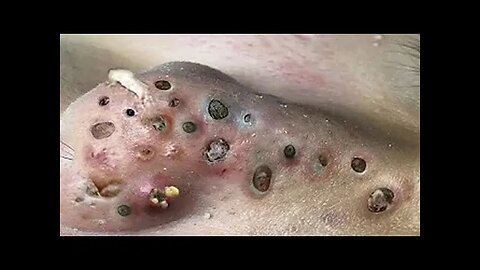 Relaxing Blackheads Removal Big Cystic Acne Extraction Whiteheads Pimple Popping