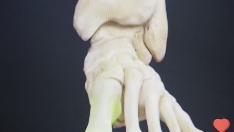 Got Bunions ? Here's why with Eden's Living TV