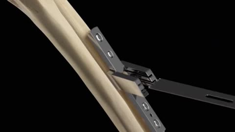 Ulnar Bone Shortening Osteotomy 3D Animation