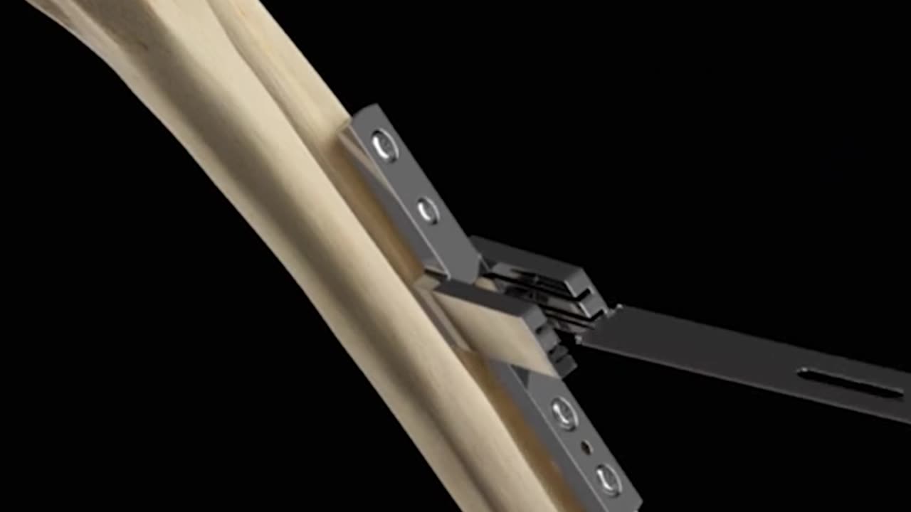 Ulnar Bone Shortening Osteotomy 3D Animation