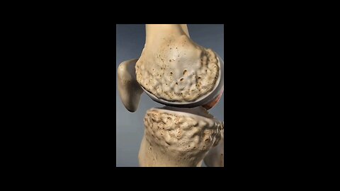 Total knee replacement #Bones#BoneHealth#BoneCare#StrongBones#BoneStrength#BoneHealing#BoneInjury
