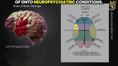mRNA "vaccines" function as chemical lobotomies. Causing SEVERE brain damage
